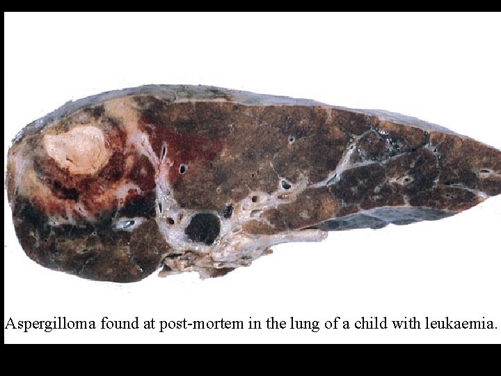 Aspergilloma found at post-mortem in the lung of a child with leukaemia. 