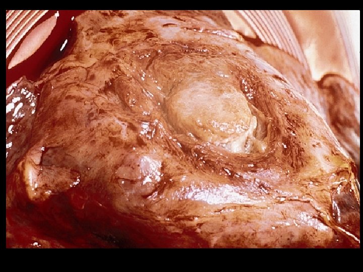 Aspergilloma found at post-mortem in the lung of a child with leukaemia. 