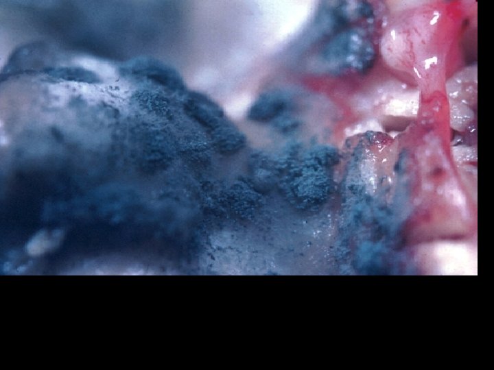 Aspergillosis in air sacs of a hen during an epidemic of aspergillosis in poultry.