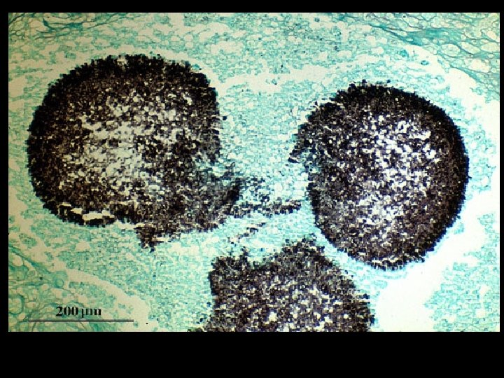 Grocott’s methenamine silver (GMS) stained tissue section of lung showing fungal balls of hyphae