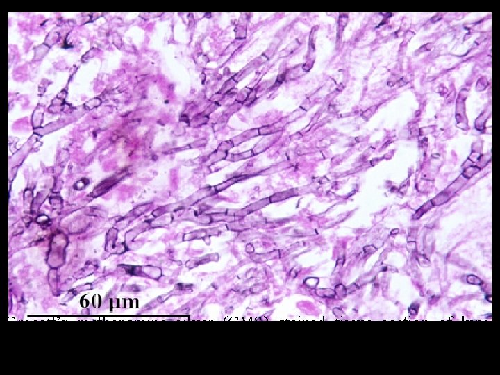 Grocott’s methenamine silver (GMS) stained tissue section of lung showing dichotomously branched, septate hyphae