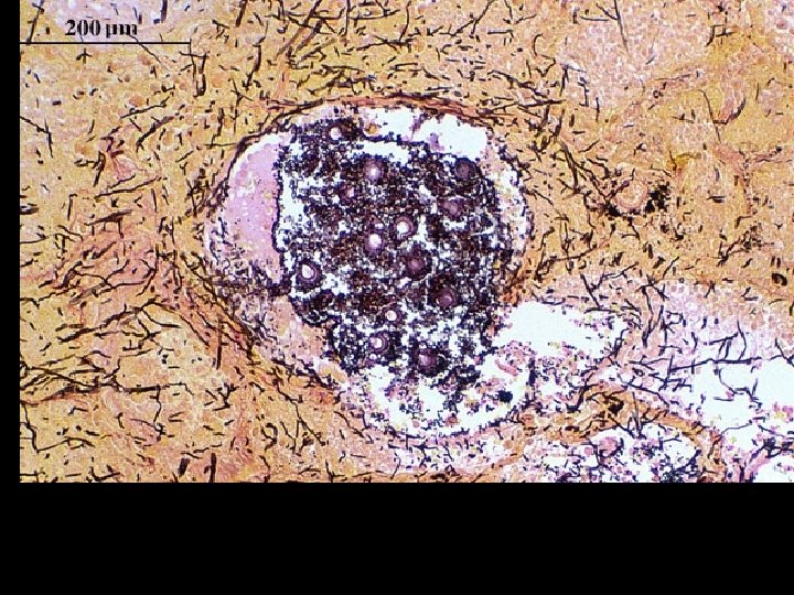 Grocott’s methenamine silver (GMS) stained tissue sections showing Aspergillus fumigatus in lung tissue, note