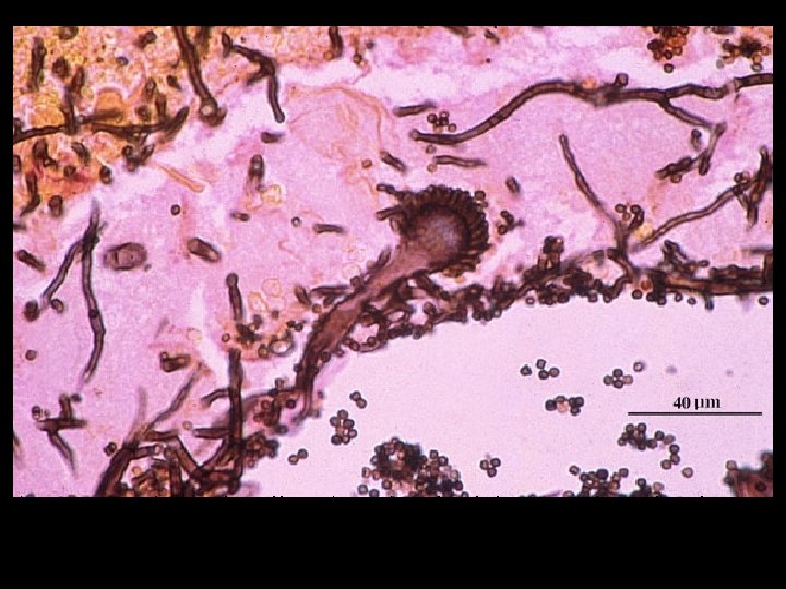 Grocott’s methenamine silver (GMS) stained tissue sections showing Aspergillus fumigatus in lung tissue, note