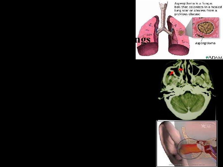 If fungus balls grow near lungs. Blood vessels removed surgically Sinuses aspergillosis removed surgically