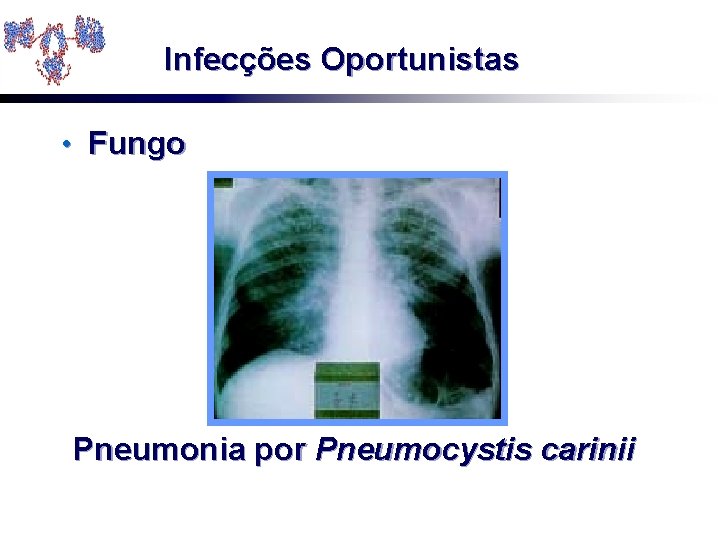 Infecções Oportunistas • Fungo Pneumonia por Pneumocystis carinii 