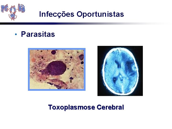 Infecções Oportunistas • Parasitas Toxoplasmose Cerebral 