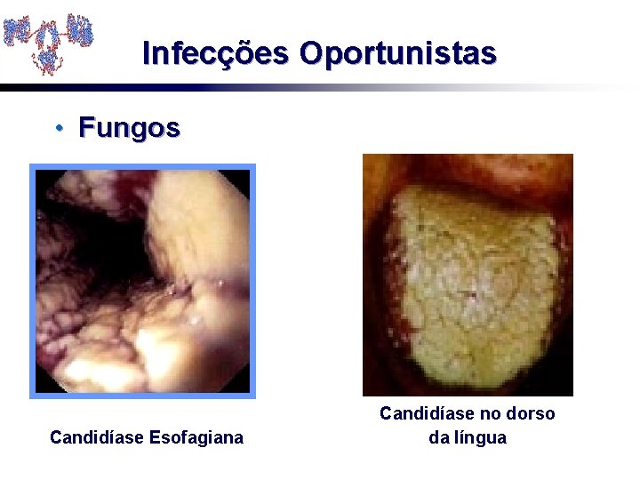 Infecções Oportunistas • Fungos Candidíase Esofagiana Candidíase no dorso da língua 