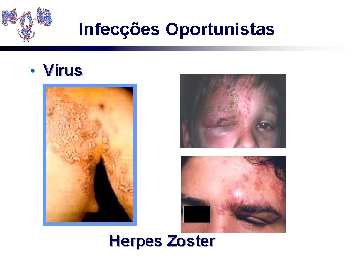 Infecções Oportunistas • Vírus Herpes Zoster 