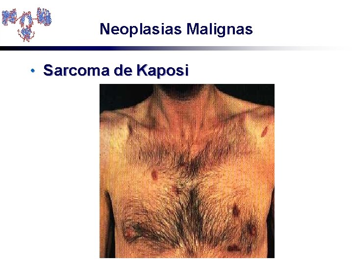 Neoplasias Malignas • Sarcoma de Kaposi 
