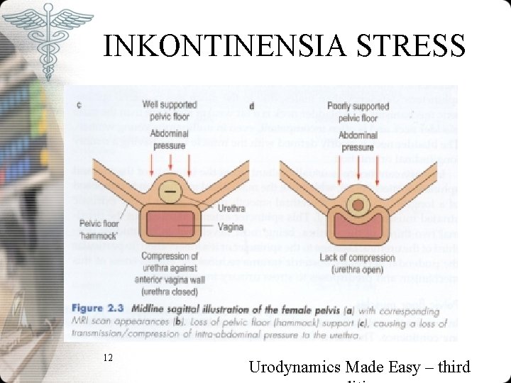 INKONTINENSIA STRESS 12 Urodynamics Made Easy – third INKONTINENSIA STRESS 12 Urodynamics Made Easy – third