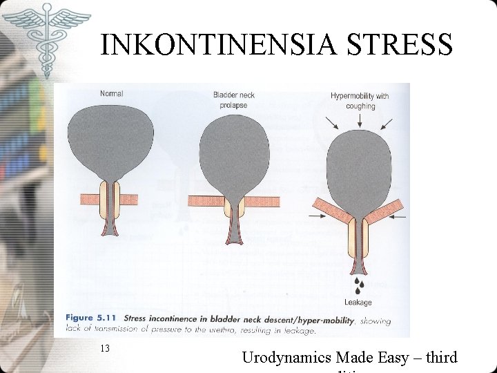 INKONTINENSIA STRESS 13 Urodynamics Made Easy – third INKONTINENSIA STRESS 13 Urodynamics Made Easy – third