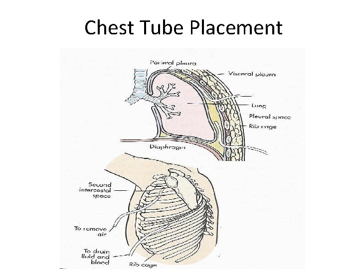 Chest Tube Placement 