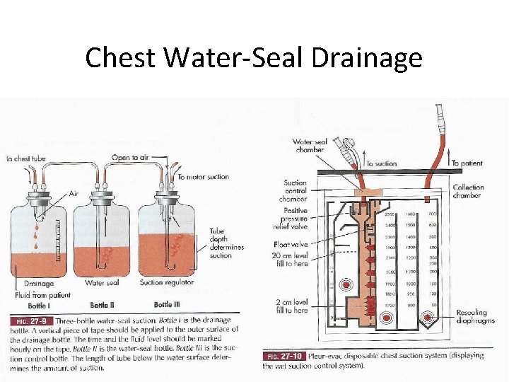 Chest Water-Seal Drainage 