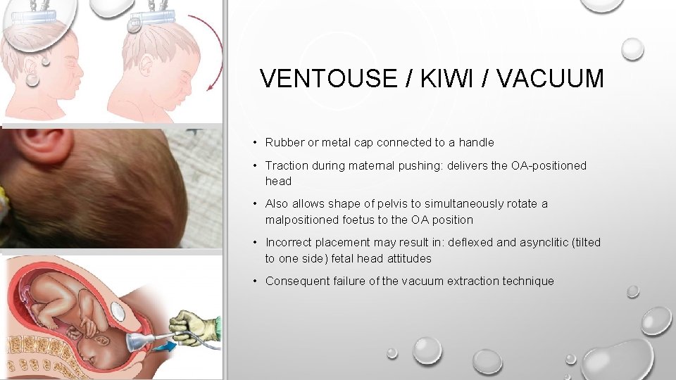 VENTOUSE / KIWI / VACUUM • Rubber or metal cap connected to a handle
