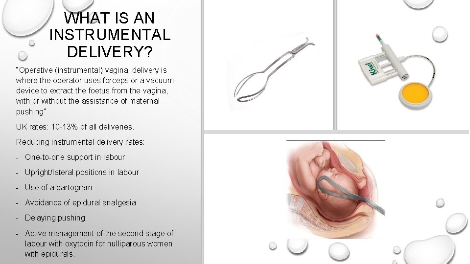 WHAT IS AN INSTRUMENTAL DELIVERY? “Operative (instrumental) vaginal delivery is where the operator uses