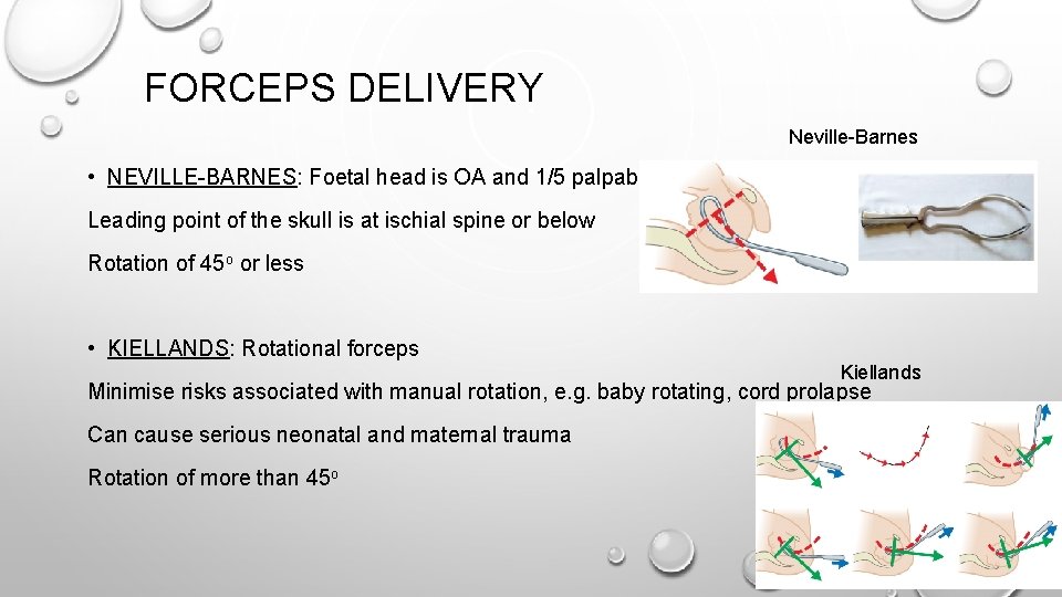 FORCEPS DELIVERY Neville-Barnes • NEVILLE-BARNES: Foetal head is OA and 1/5 palpable Leading point