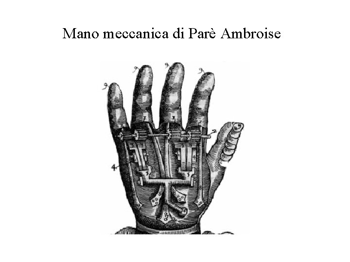 Mano meccanica di Parè Ambroise 