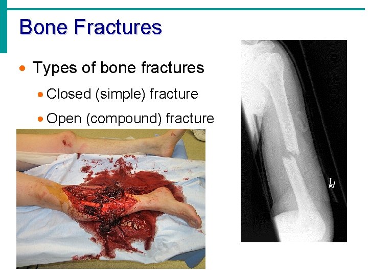 Bone Fractures · Types of bone fractures · Closed (simple) fracture · Open (compound)