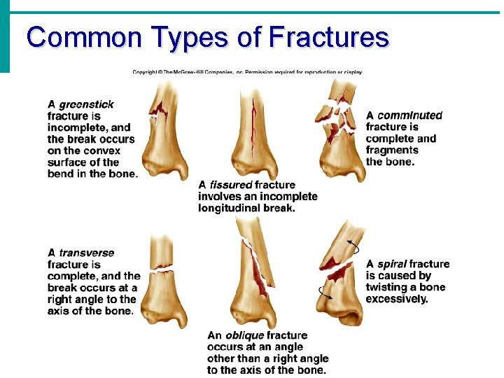 Common Types of Fractures Common Types of Fractures