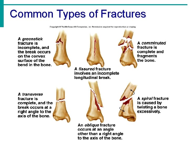 Common Types of Fractures 