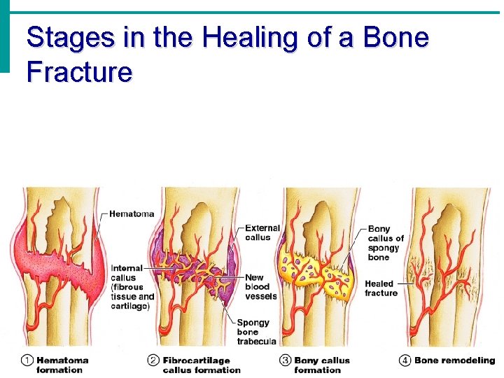 Stages in the Healing of a Bone Fracture Stages in the Healing of a Bone Fracture