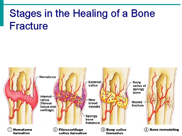 Stages in the Healing of a Bone Fracture 