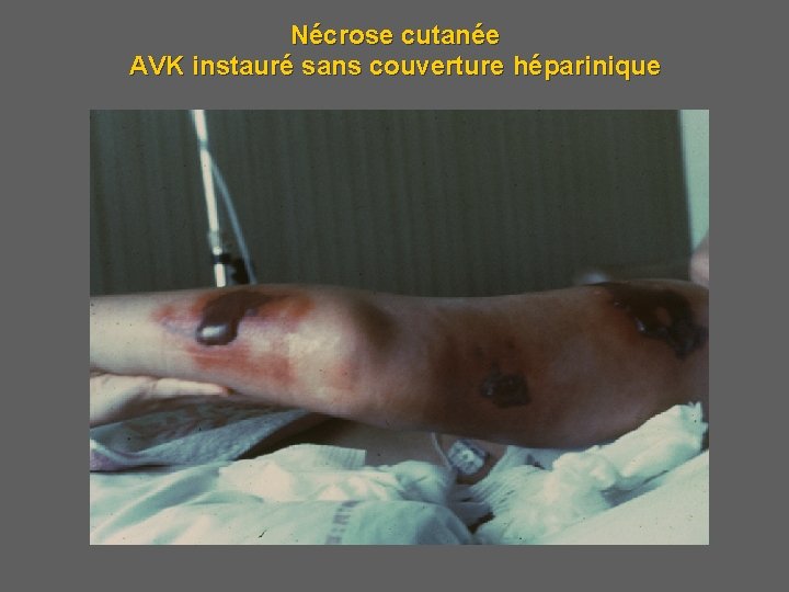 Nécrose cutanée AVK instauré sans couverture héparinique 