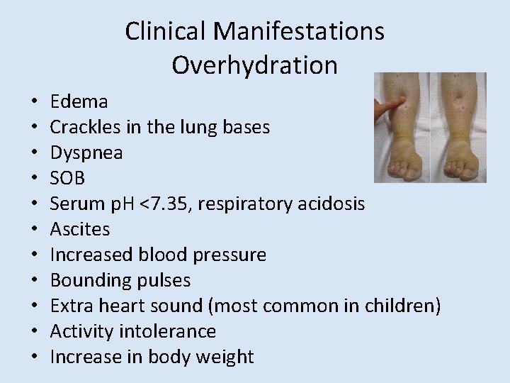 Clinical Manifestations Overhydration • • • Edema Crackles in the lung bases Dyspnea SOB