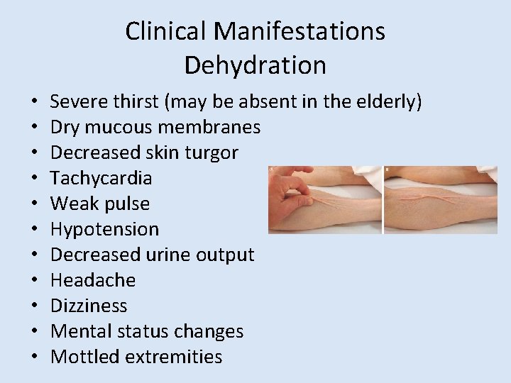 Clinical Manifestations Dehydration • • • Severe thirst (may be absent in the elderly)