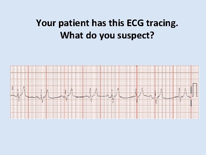 Your patient has this ECG tracing. What do you suspect? 