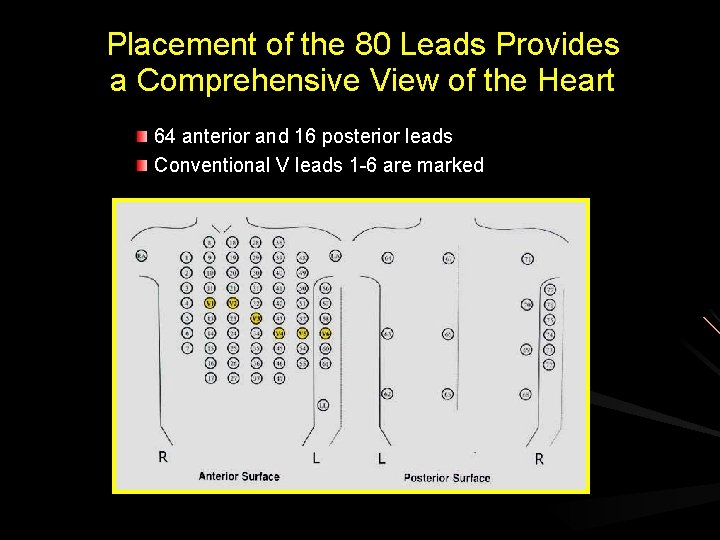 Placement of the 80 Leads Provides a Comprehensive View of the Heart 64 anterior