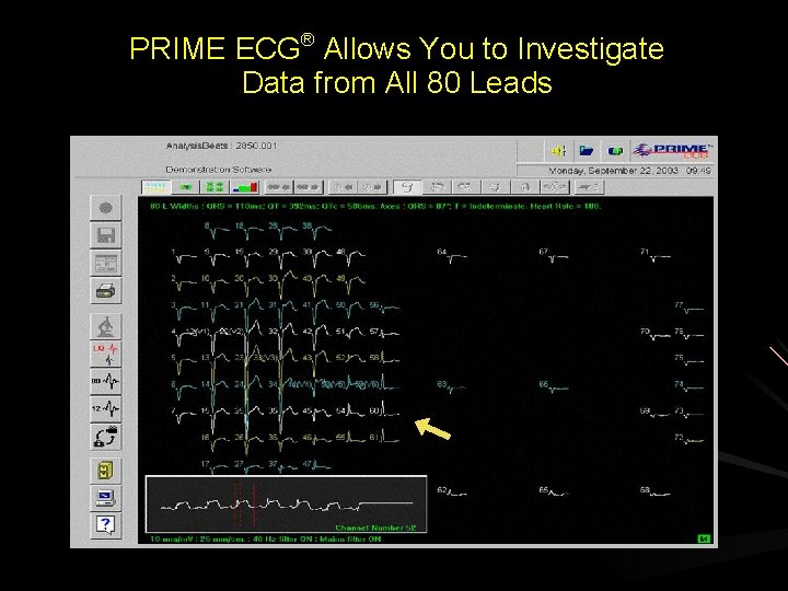 PRIME ECG® Allows You to Investigate Data from All 80 Leads View a single