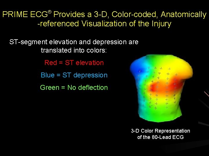 PRIME ECG® Provides a 3 -D, Color-coded, Anatomically -referenced Visualization of the Injury ST-segment