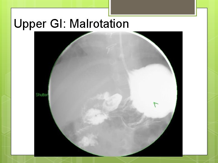 Upper GI: Malrotation 