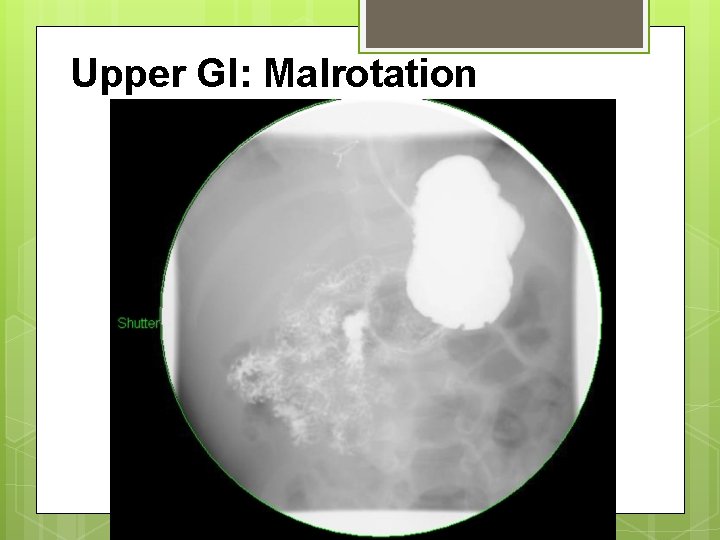 Upper GI: Malrotation 