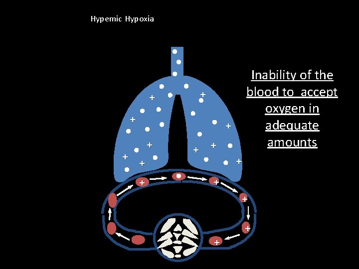Hypemic Hypoxia + + + Inability of the blood to accept oxygen in adequate