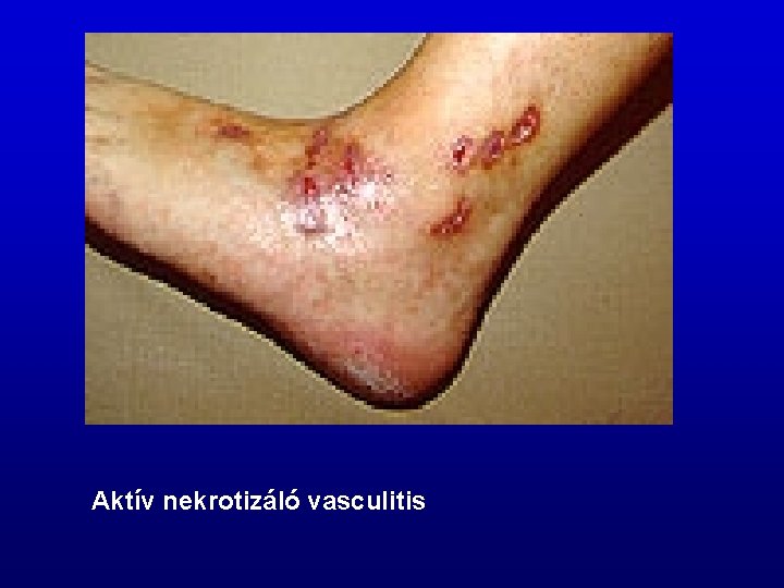 Vaszkulitisz (érgyulladás), Szisztémás kötőszöveti betegség vaszkulitisz