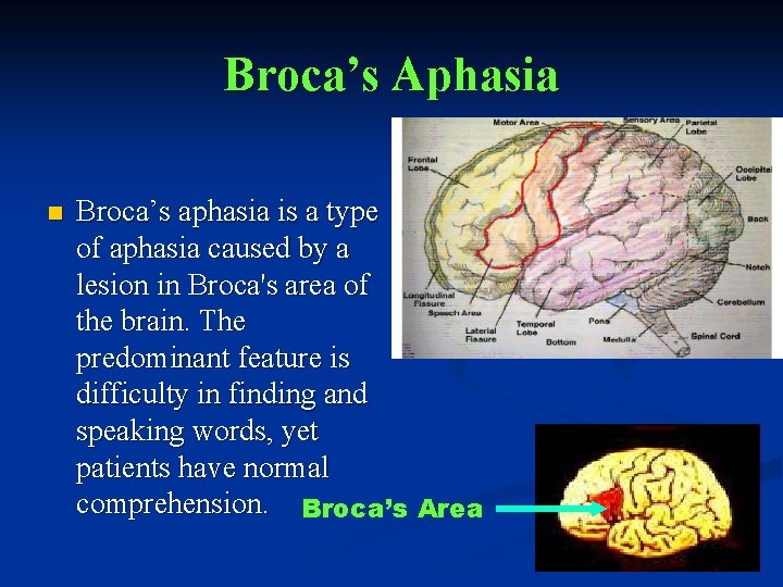 Broca’s Aphasia n Broca’s aphasia is a type of aphasia caused by a lesion