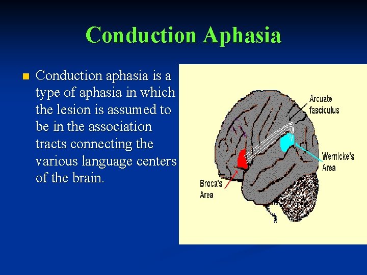 Conduction Aphasia n Conduction aphasia is a type of aphasia in which the lesion