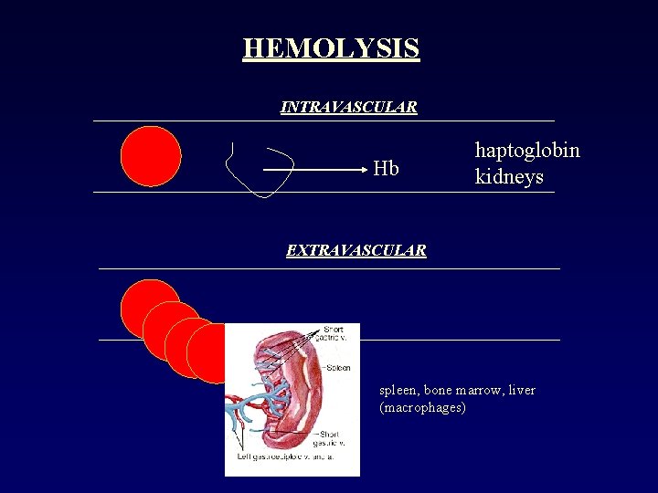 HEMOLYSIS INTRAVASCULAR Hb haptoglobin kidneys EXTRAVASCULAR spleen, bone marrow, liver (macrophages) 