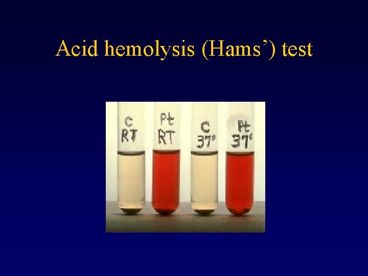 Acid hemolysis (Hams’) test 