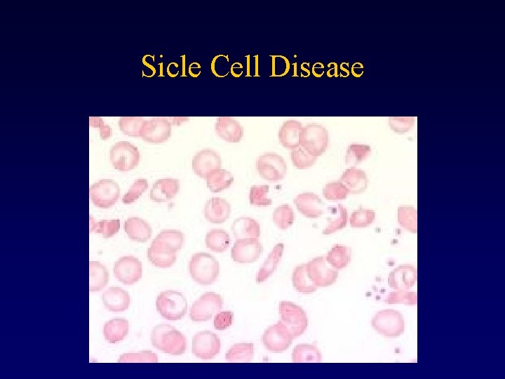 Sicle Cell Disease 