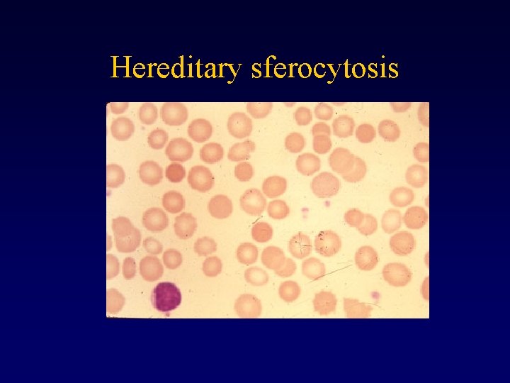 Hereditary sferocytosis 