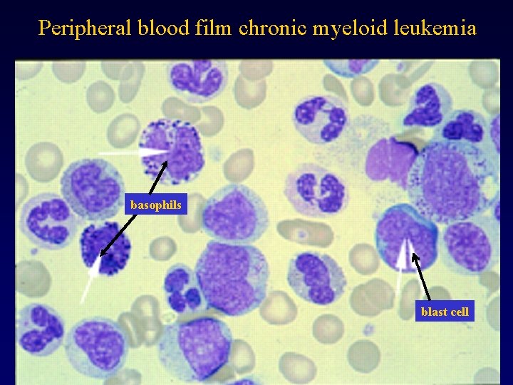 Peripheral blood film chronic myeloid leukemia basophils blast cell 