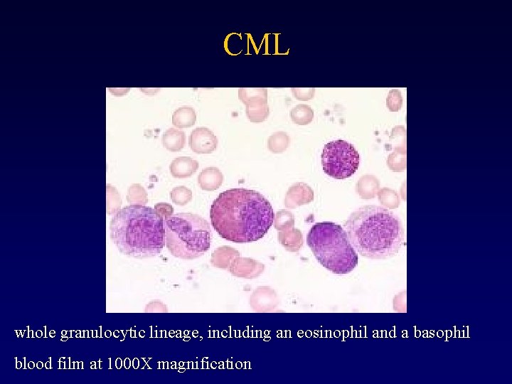 CML whole granulocytic lineage, including an eosinophil and a basophil blood film at 1000