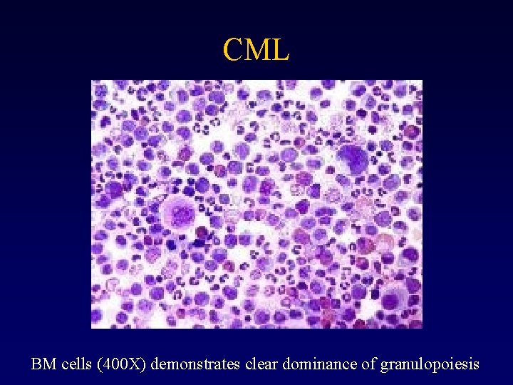 CML BM cells (400 X) demonstrates clear dominance of granulopoiesis 