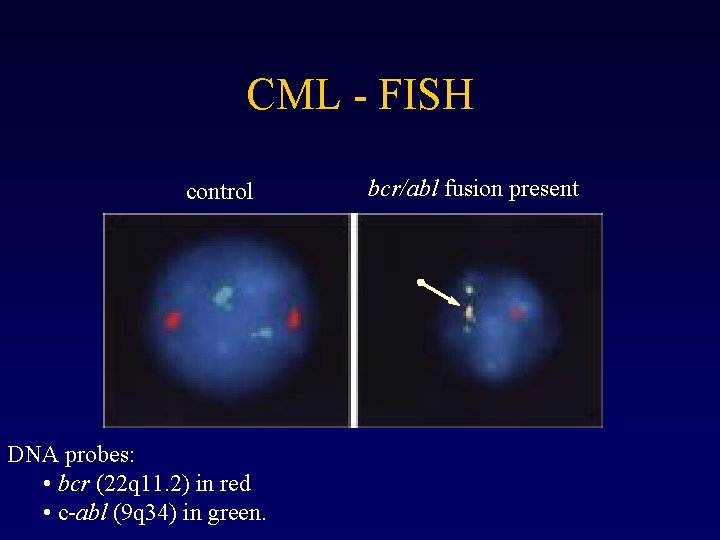CML - FISH control DNA probes: • bcr (22 q 11. 2) in red
