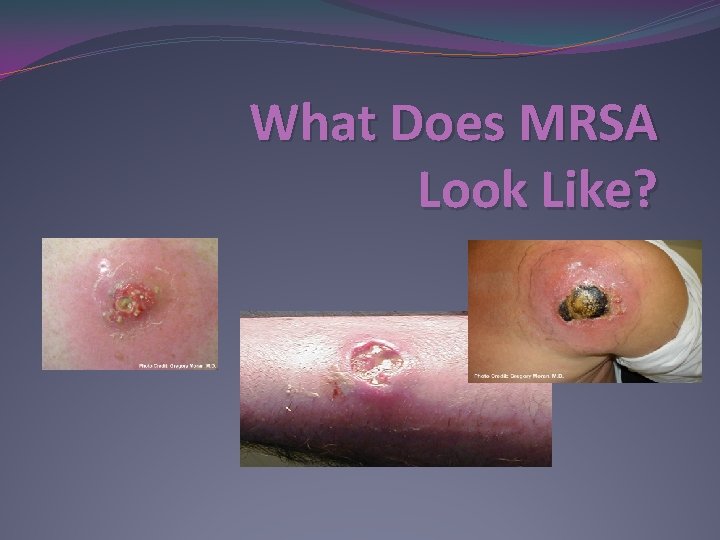 What Does MRSA Look Like? 