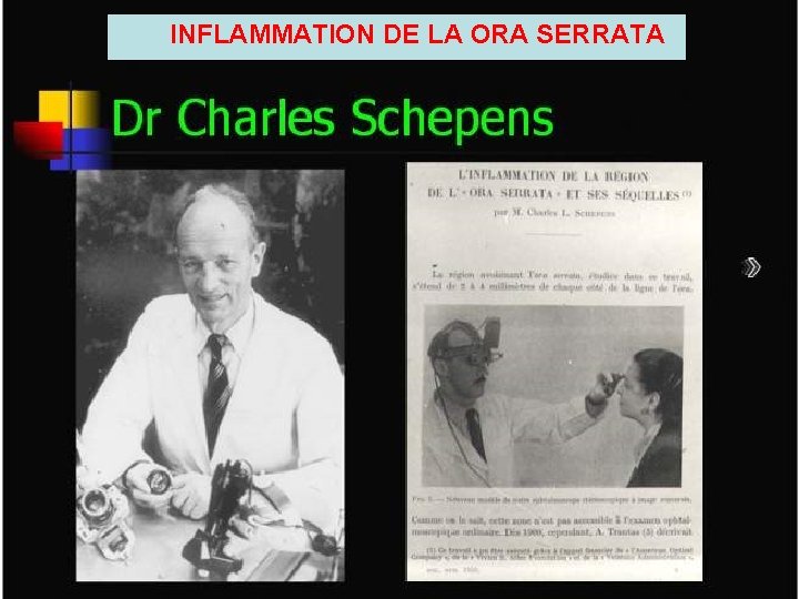 INFLAMMATION DE LA ORA SERRATA 