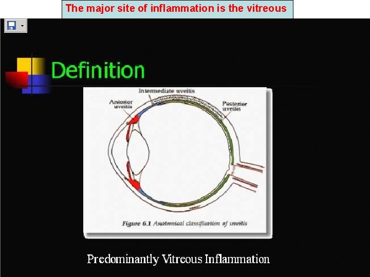 The major site of inflammation is the vitreous 